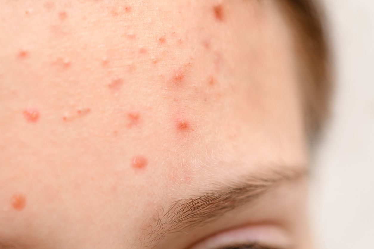 Kulit berjerawat hanya bisa diatasi dengan penggunaan skincare yang tepat. Menurut ahli inicara memilih skincare yang benar untuk atasi jerawat. 