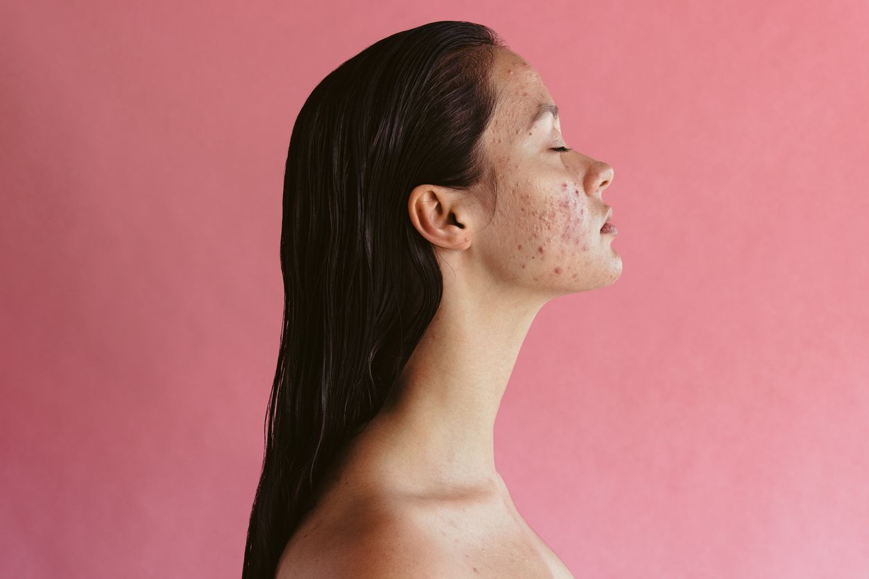 Berikut ini 5 tips memilih sunscreen untuk pemilik kulit berminyak dan berjerawat yang viral di TikTok