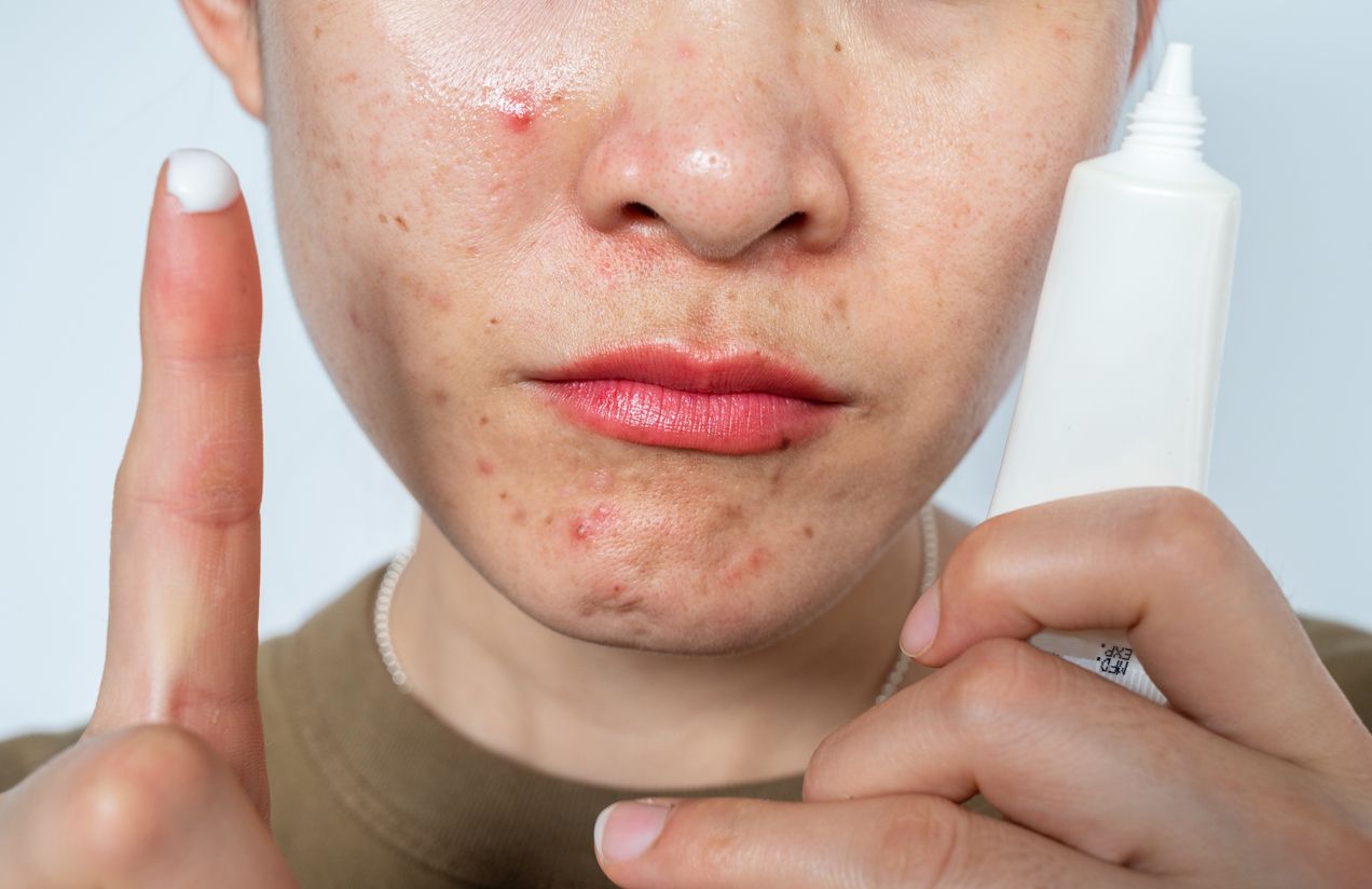 Berikut ini penjelasan mengenai apa itu adapalene, salah satu skincare topikal viral di TikTok yang ampuh atasi jerawat