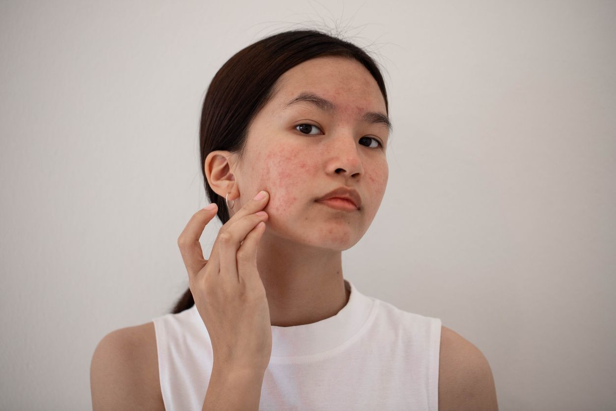Berikut ini cara memakai adapalene, yang merupakan skincare viral di TikTok karena katanya ampuh atasi jerawat