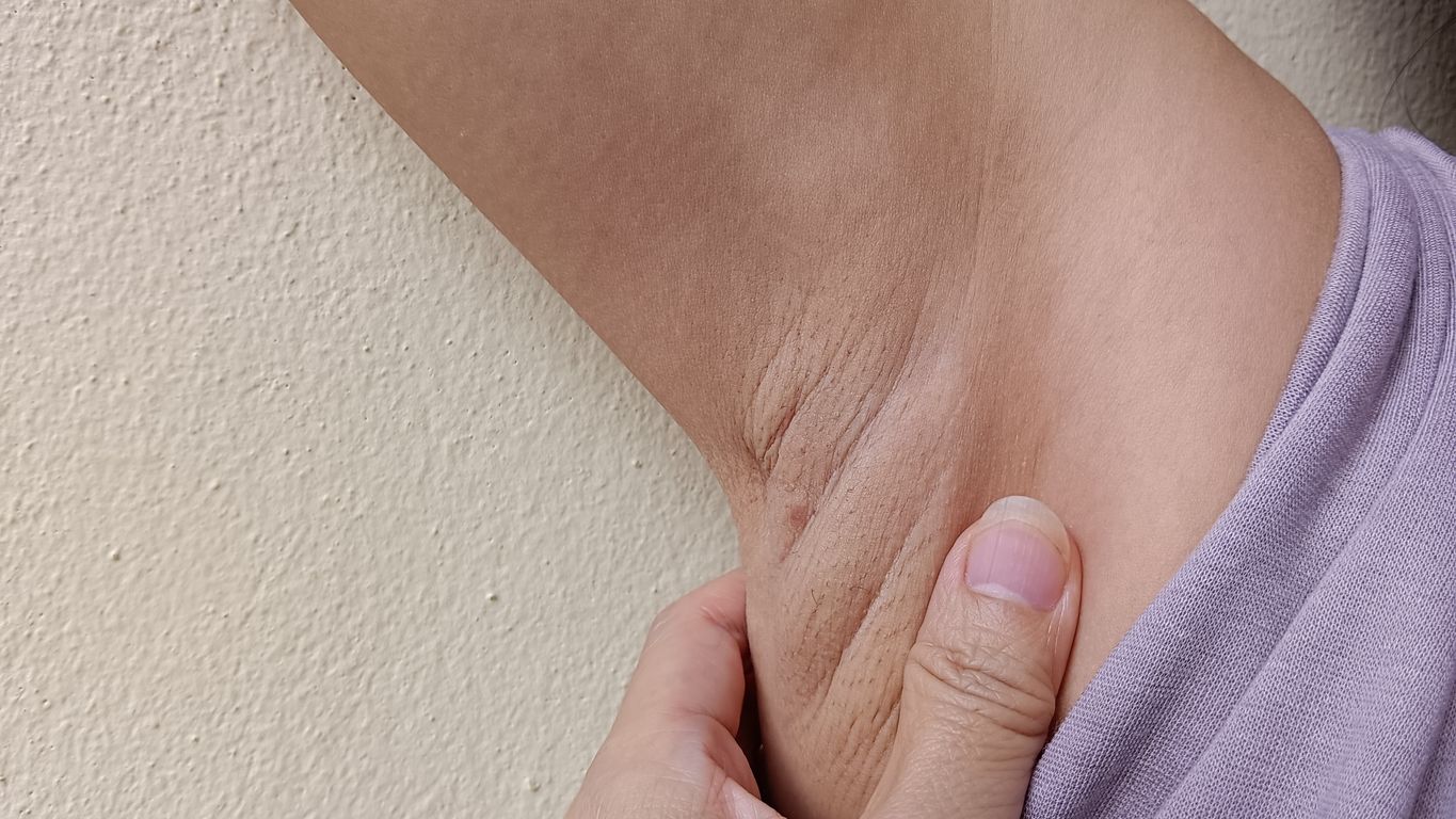 Berikut 5 gejala ingrown hair di ketiak akibat waxing dan mencukur, bisa gatal hingga hiperpigmentasi. Segera atasi!