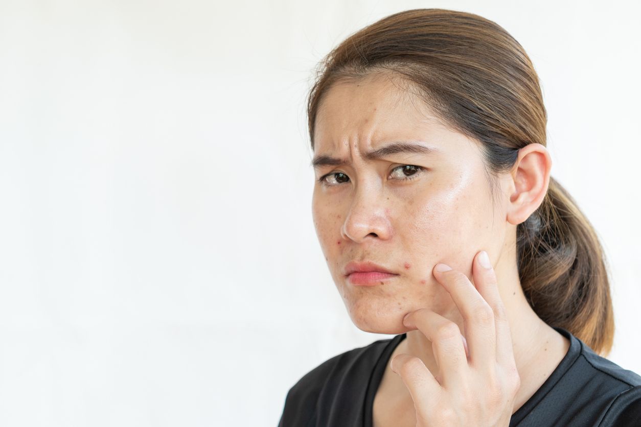 Berikut ini penjelasan mengenai apa itu tretinoin yang viral di TikTok, dikatakan ampuh mengatasi kerutan dan masalah lainnya.