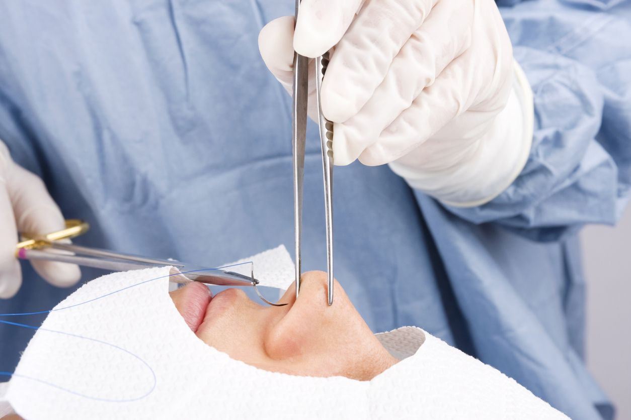 Berikut ini 3 manfaat rhinoplasty yang viral di TikTok, tentunya bukan sekadar untuk estetika saja loh, Kawan Puan