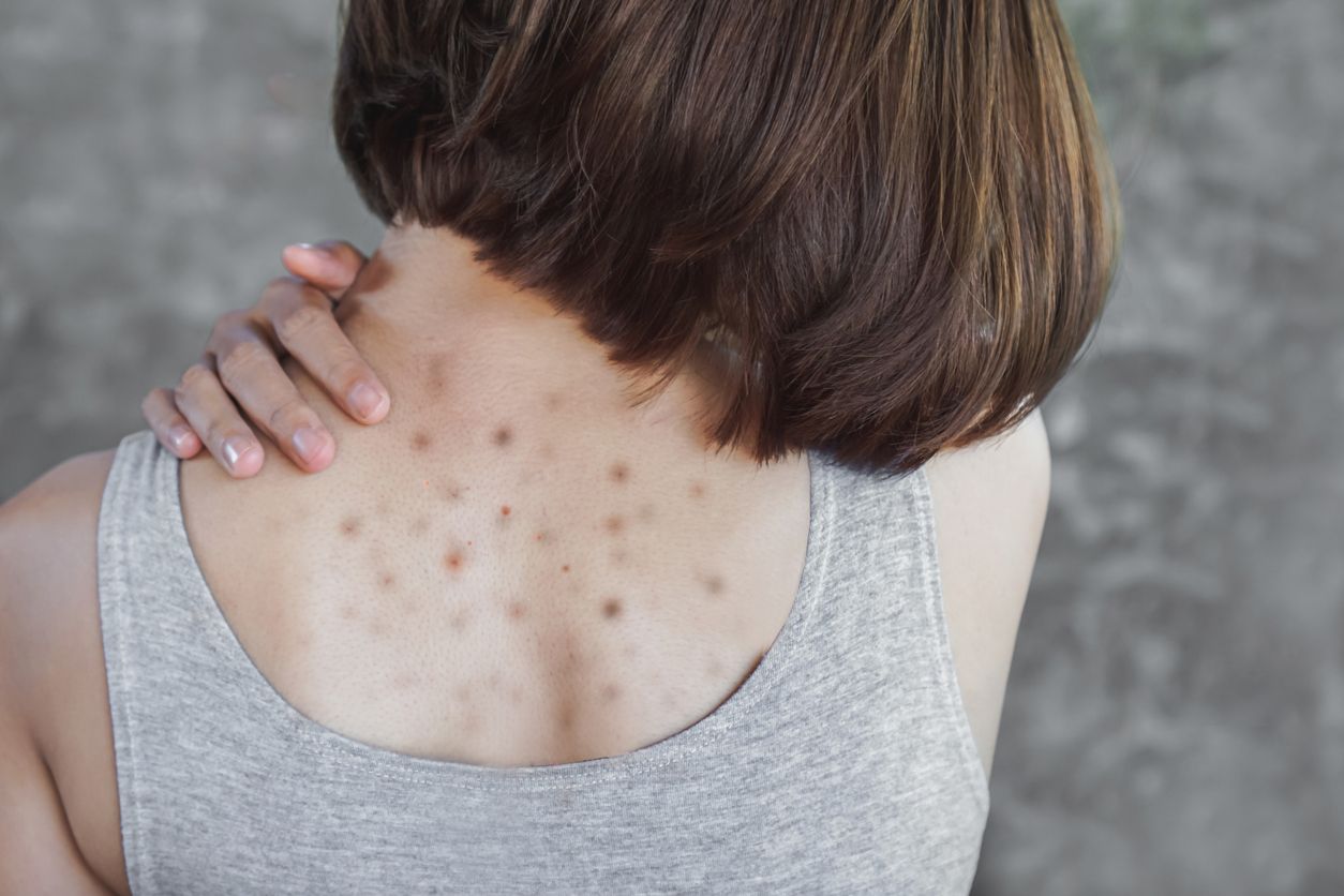 Jerawat juga bisa muncul di berbagai area tubuh, mulai dari punggung, dada hingga bokong. Ini rekomendasi body acne care.