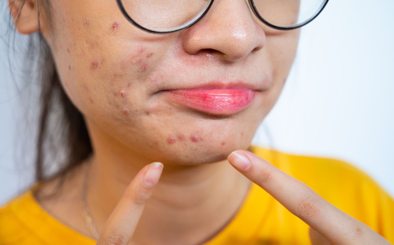 Pemilik kulit berjerawat harus hati-hati, ini dia produk skincare yang bikin jerawat jadi makin parah, salah satunya oil-based formula.