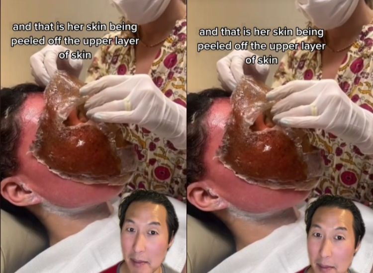 Berikut penjelalasan tentang phenol peel, treatment wajah yang jadi viral di TikTok. Simak selengkapnya!
