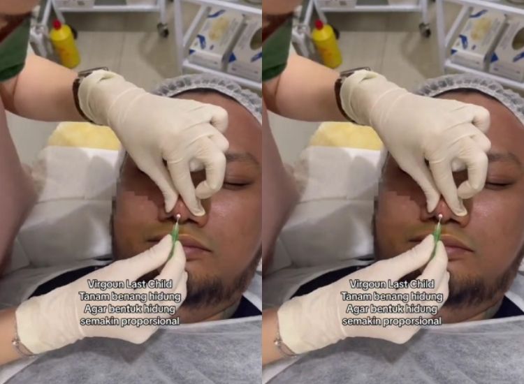 Virgoun Last Child melakukan prosedur kecantikan yang dinamakan tanam benang hingga viral di TikTok.