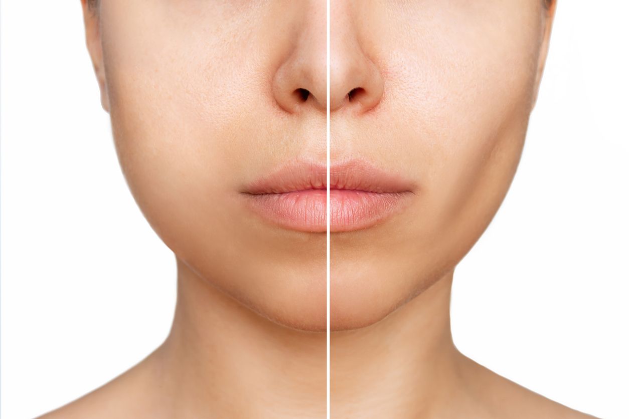 Berikut ini pengertian mengenai apa itu buccal fat removal, operasi penghilang lemak yang kini sedang viral di TikTok.