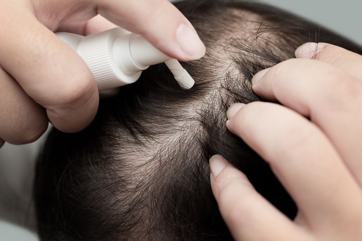 Berikut penjelasan dokter viral di TikTok soal cara penggunaan dan tips memakai minoxidil untuk mengatasi kebotakan dan mendukung pertumbuhan rambut.