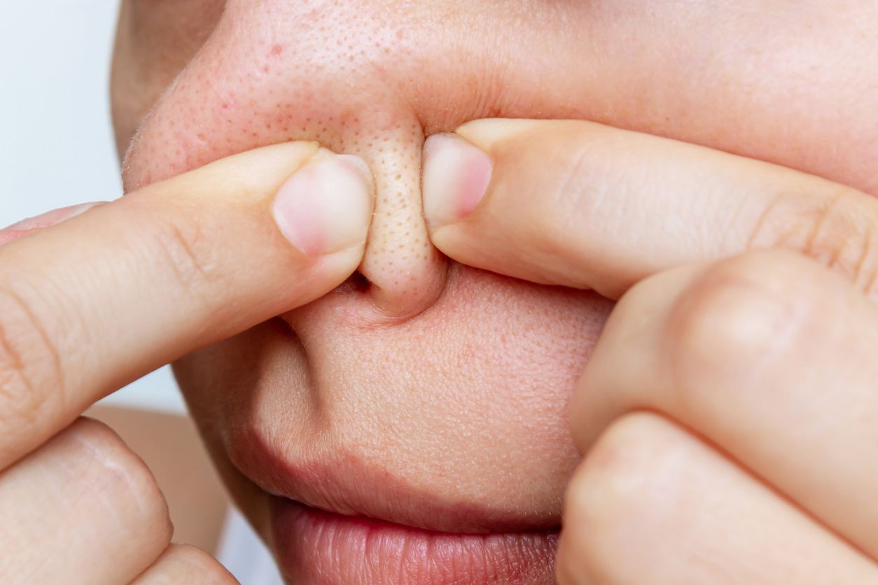 Berikut ini 4 tips membersihkan blackhead yang viral di TikTok, pastikan jangan asal memencet komedo
