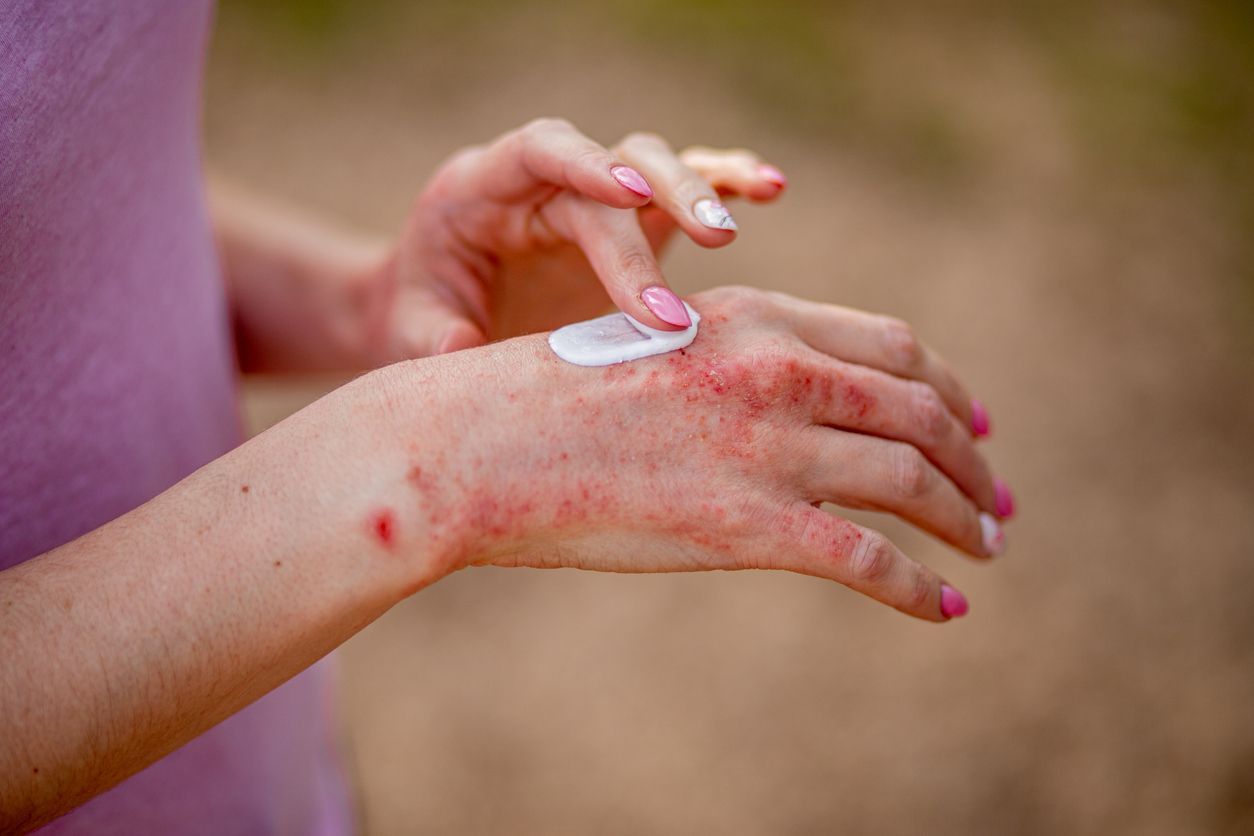 Bertepatan dengan Psoriasis Awareness Month, berikut ini 4 cara mencegah kekambuhan psoriasis, simak selengkapnya.