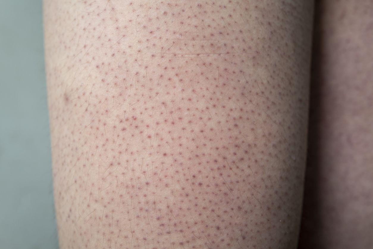 Berikut 3 tips merawat keratosis pilaris atau chicken skin, kondisi kulit yang viral di TikTok. Simak penjelasannya!