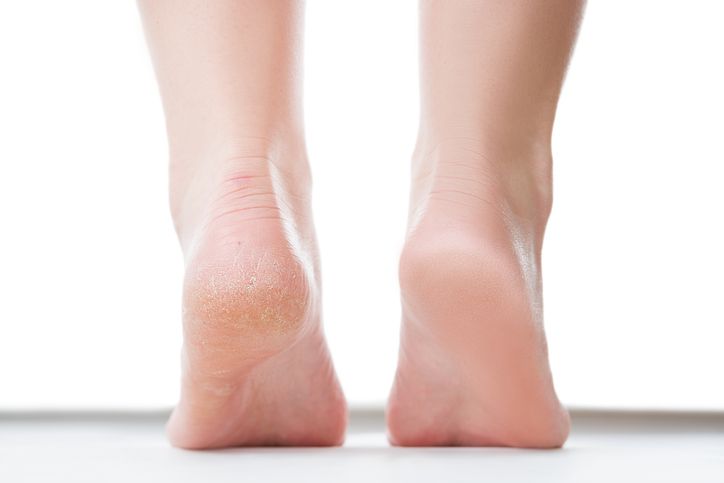 Sering dialami banyak orang, berikut ini tiga penyebab telapak kaki pecah-pecah. Lantas, apa saja penyebabnya?