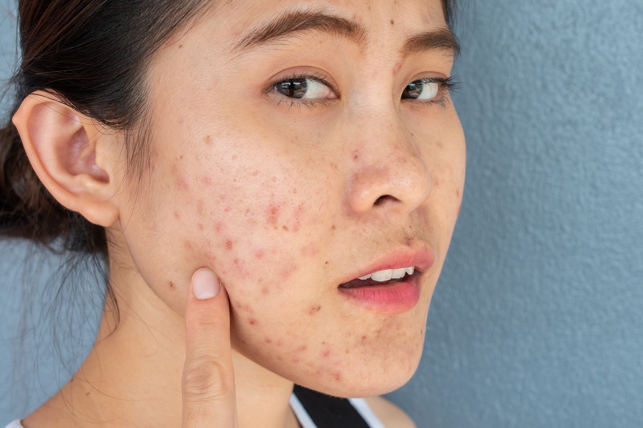 Berikut ini rekomendasi skincare untuk pejuang jerawat yang viral di TikTok, namanya yakni Forebie, simak ya