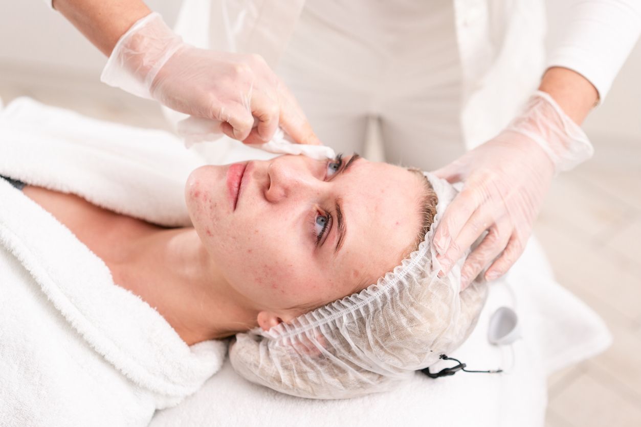 Untuk menghilangkan bekas jerawat tak cukup pakai skincare. Ini rekomendasi perawatan untuk hilangkan bopeng di FTP Aesthetics Clinic.