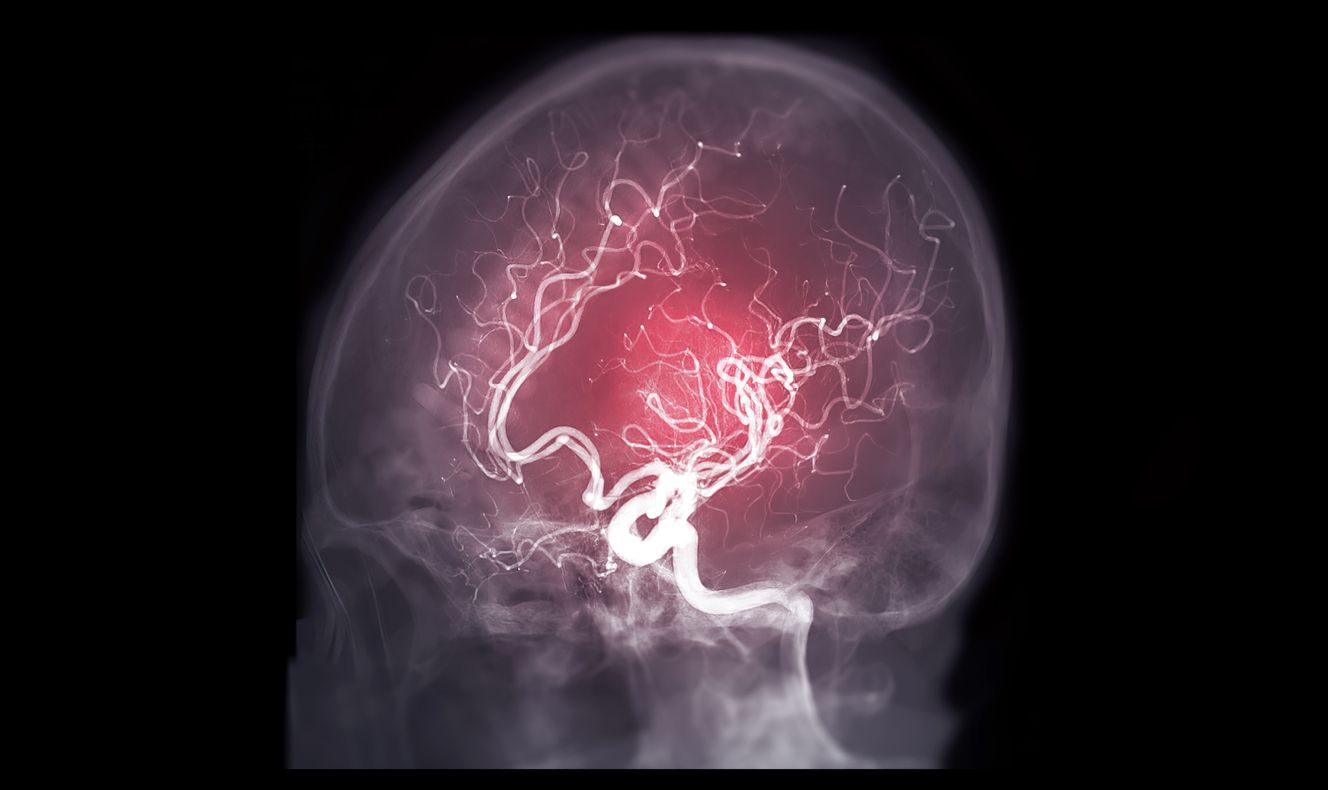 Berikut ini penjelasan dari dokter spesialis bedah mengenai kenapa perempuan lebih berisiko mengalami aneurisme otak