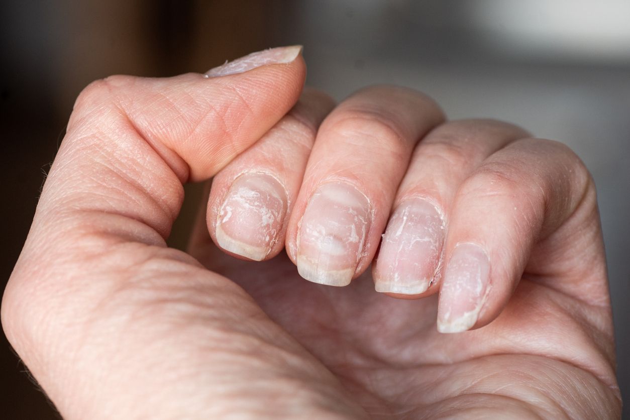 Kabar tiktokers yang mengalami kuku jamuran akibat nail extension viral di TikTok, simak berbagi cara untuk mengatasinya