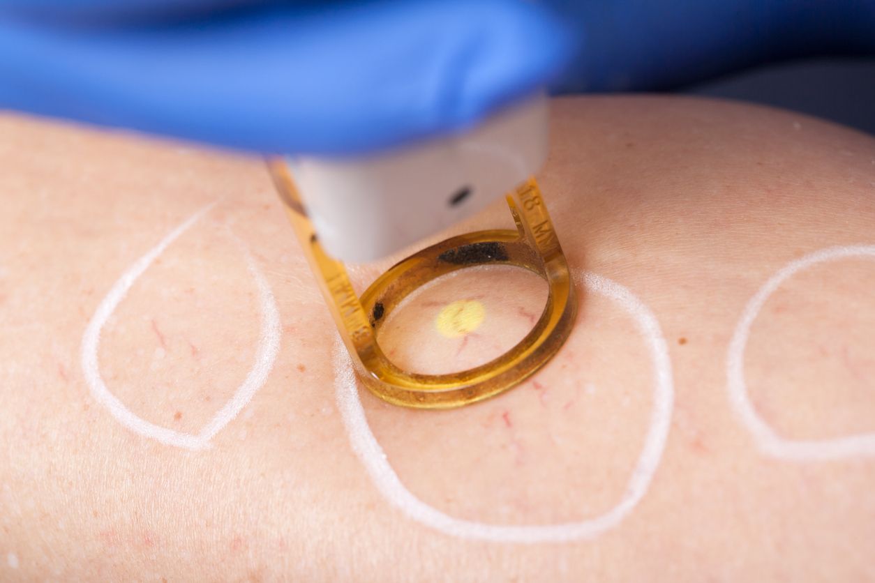 Berikut ini penjelasang mengenai vascular laser yang viral di TikTok karena bantu atasi bekas jerawat kemerahan.