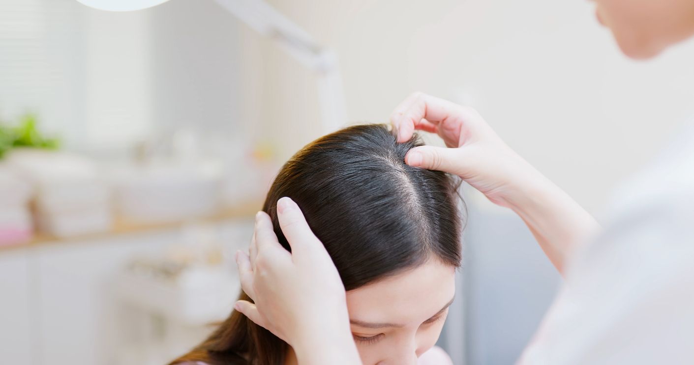Berikut ini 3 cara mengatasi jerawat di kulit kepala, salah satunya pakai sampo salicylic acid, simak selengkapnya.