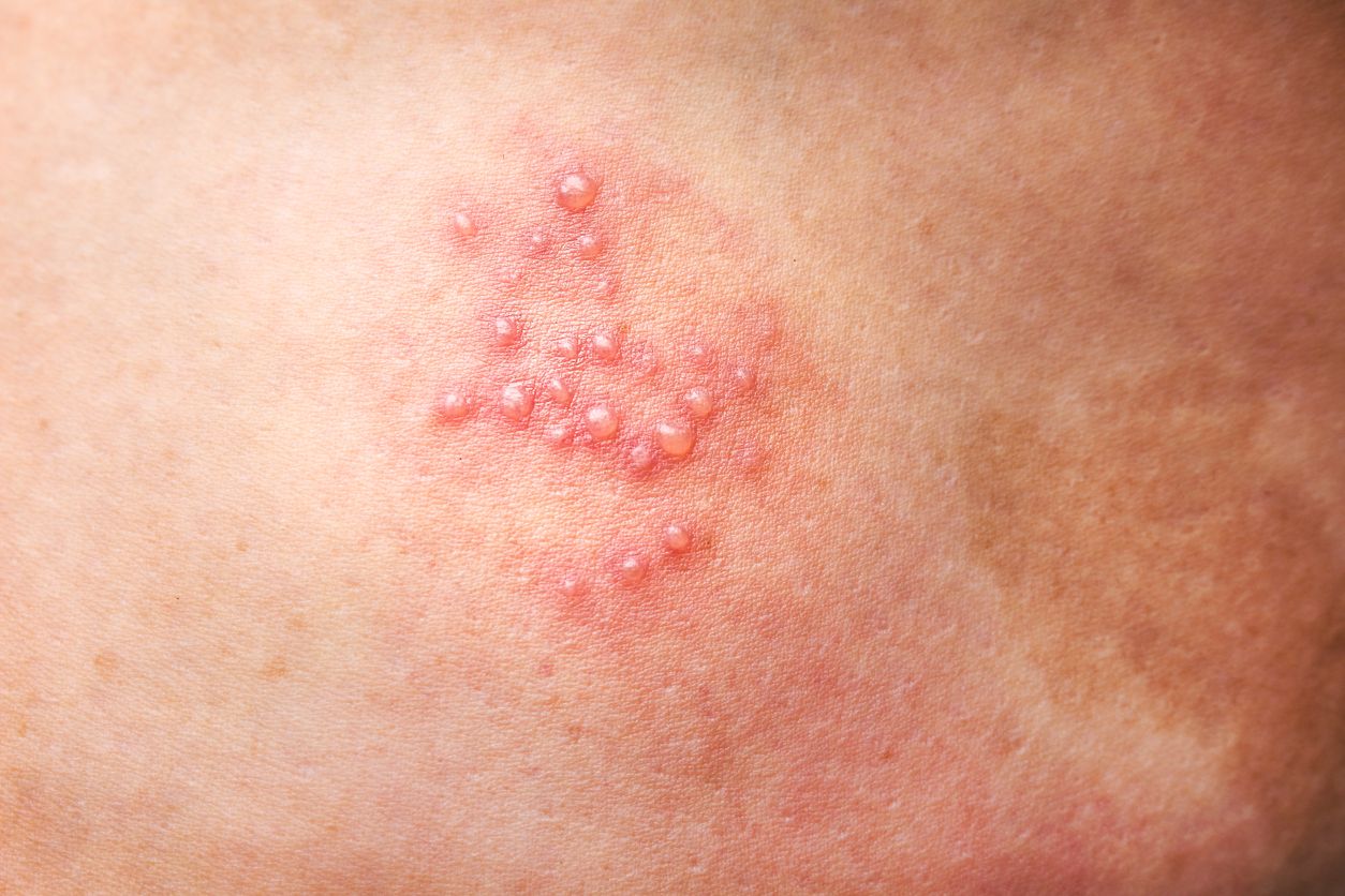 Viral di TikTok, berikut ini penjelasan mengenai apa itu herpes zoster yang ternyata disebabkan oleh virus varicella zoster.