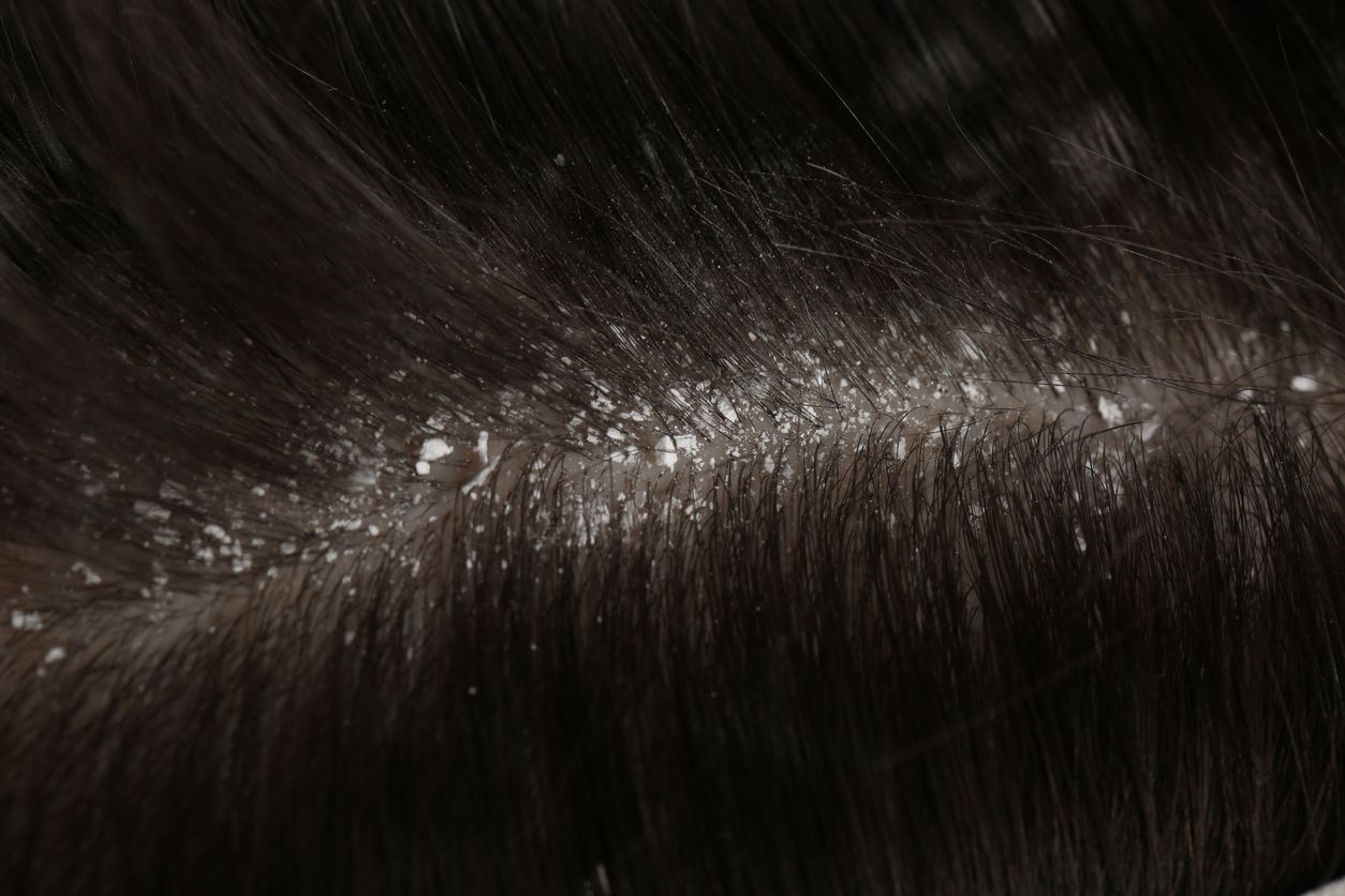 Ketombe di rambut bukan hanya mengganggu tapi bikin kurang percaya diri. Ini penyebab dan cara mengatasinya.