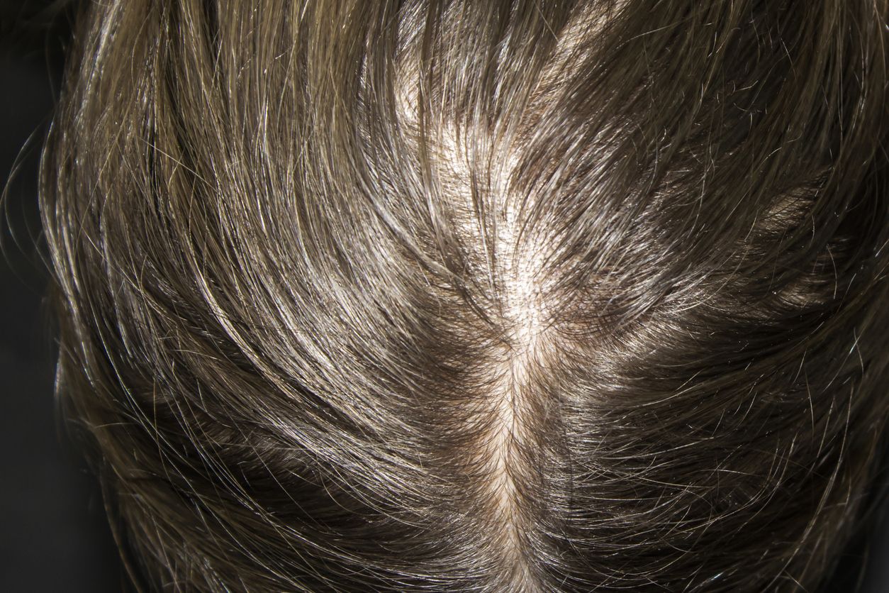 Viral di TikTok, berikut ini penjelasan dokter tentang kenapa rambut gampang lepek serta solusinya, simak selengkapnya.