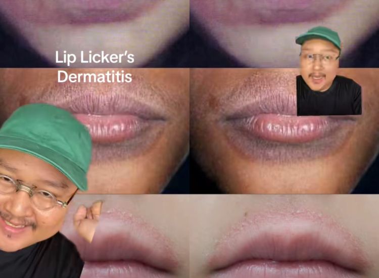 Berikut ini penjelasan menegnai apa itu lip licker's dermatitis, kondisi bibir kemerahan dan kehitaman yang viral di TikTok.