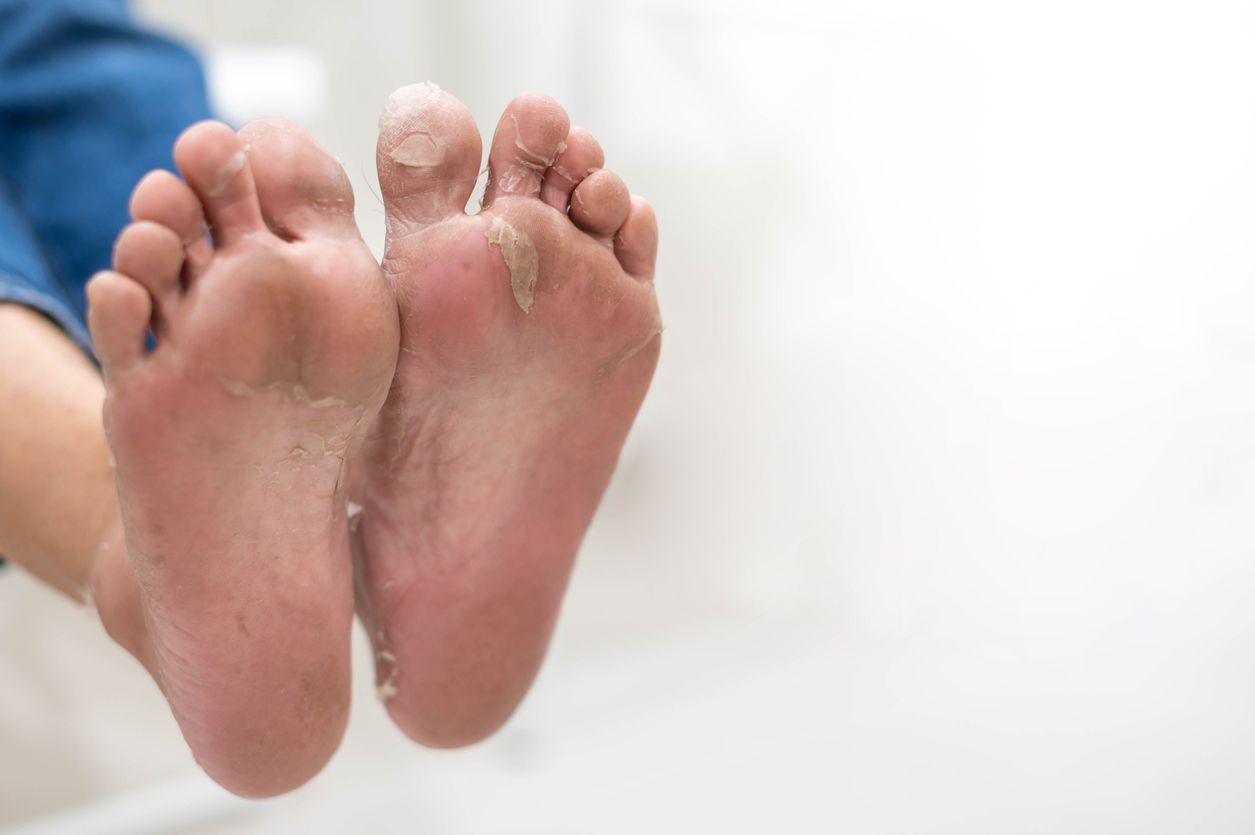 Viral di TikTok, dokter jelaskan 4 tips mengatasi kaki kapalan dan kering, salah satunya rendam di air hangat.