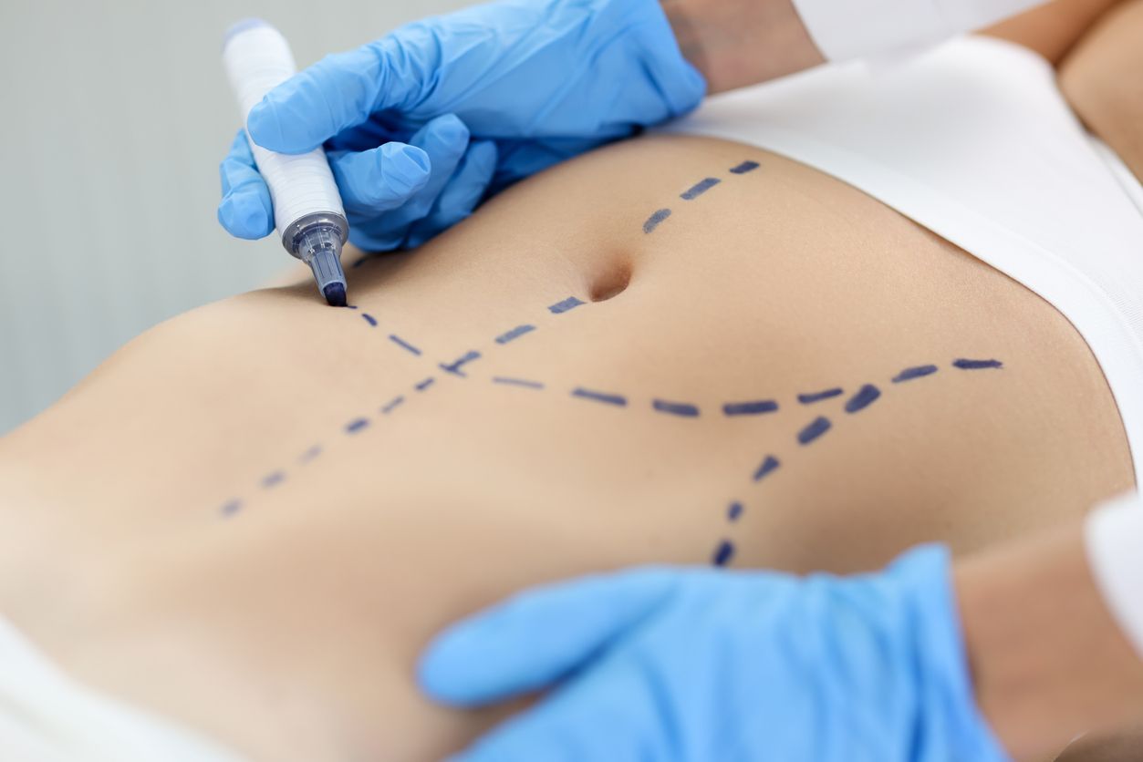 Berikut ini penjelasan mengenai apa itu tummy tuck yang termasuk salah satu operasi plastik viral di TikTok, simak selengkapnya.