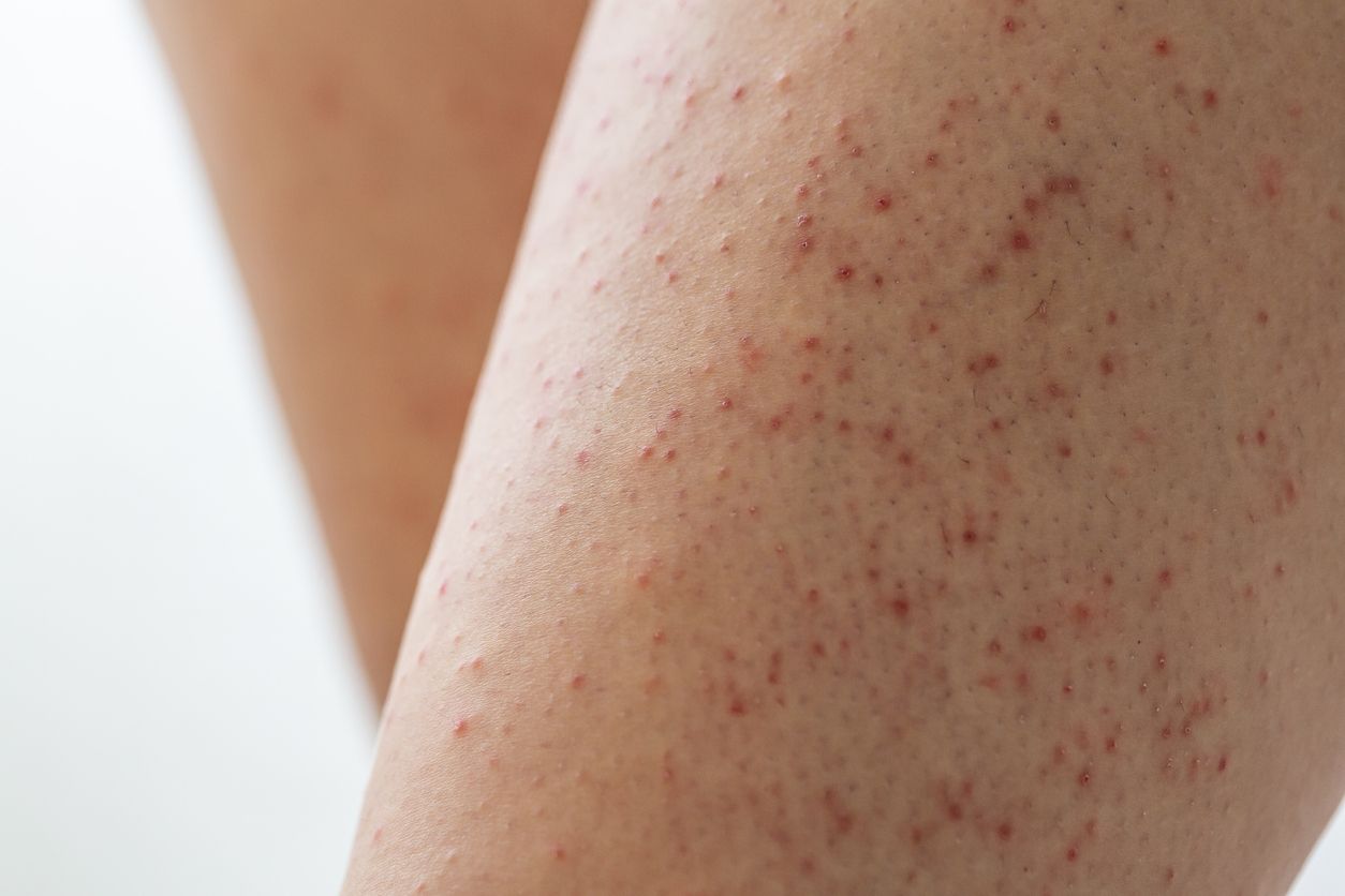 Berikut ini penjelasan mengenai penyebab keratosis pilaris, salah satu kondisi kulit viral di TikTok.