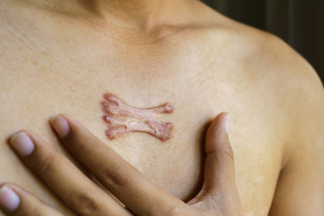 Kondisi kulit viral di TikTok, berikut ini perawatan untuk mengatasi keloid, simak penjelasan selengkapnbya.