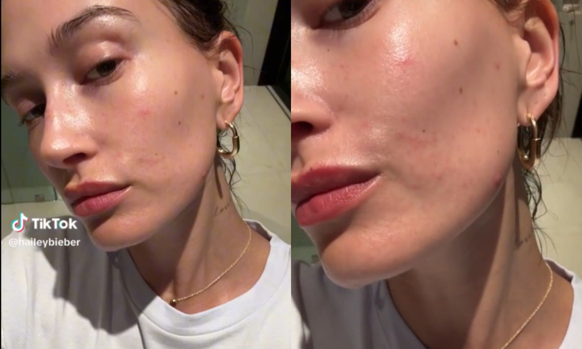 Dalam videonya yang viral di TikTok, Hailey Bieber mengaku ia mengalami perioral dermatitis. Apa itu perioral dermatitis?