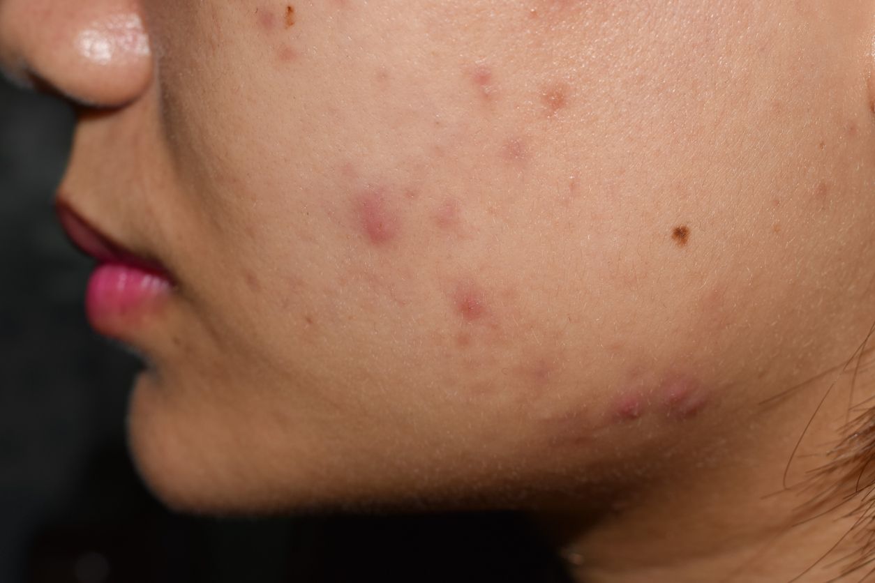 Berikut ini penjelasan mengenai allantoin, salah satu kandungan skincare viral di TikTok yang dikatakan ampuh mengatasi iritasi kulit.