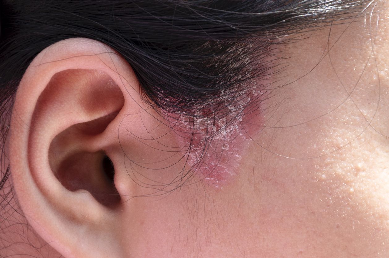 Viral di TikTok kondisi kulit wajah kemerahan hingga mengelupas ternyata kena psoriasis. Yuk, kenali penyebab psoriasis di wajah seperti berikut ini!