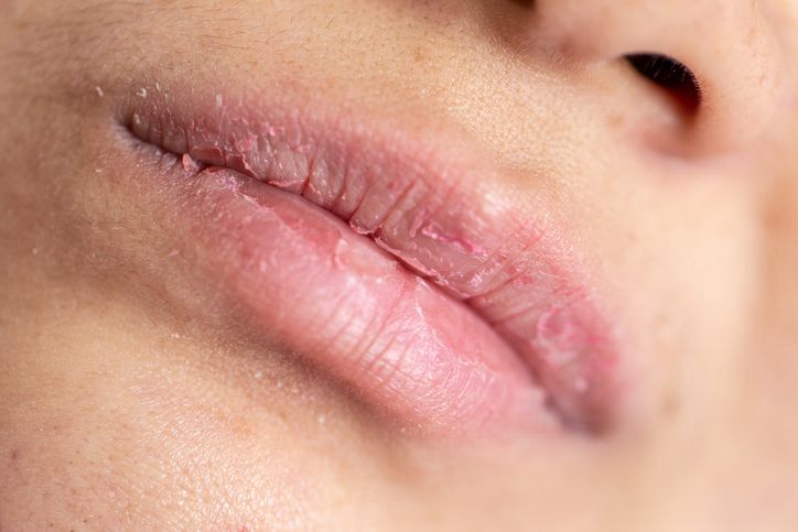Jadi masalah perempuan yang tinggal di iklim tropis, ini tips merawat kelembapan bibir dan rekomendasi produk yang bisa digunakan.