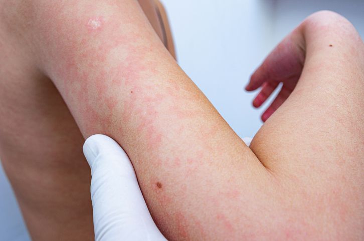 Lupus jadi masalah autoimun yang rentan menyerang anak dan perempuan, begini penjelasan dokter selengkapnya!