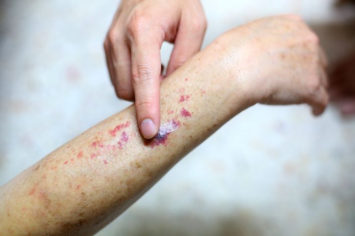 Dokter mengungkap ada tiga jenis penyakit autoimun yang sering menyerang anak-anak. Apa saja jenisnya?