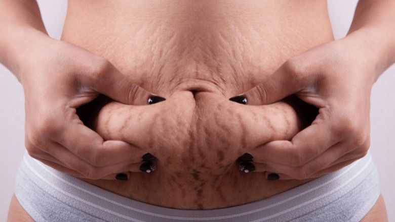Banyak perempuan mengalami perubahan kulit setelah melahirkan, terutama munculnya stretch mark yang dapat dikelola dengan berbagai perawatan efektif.