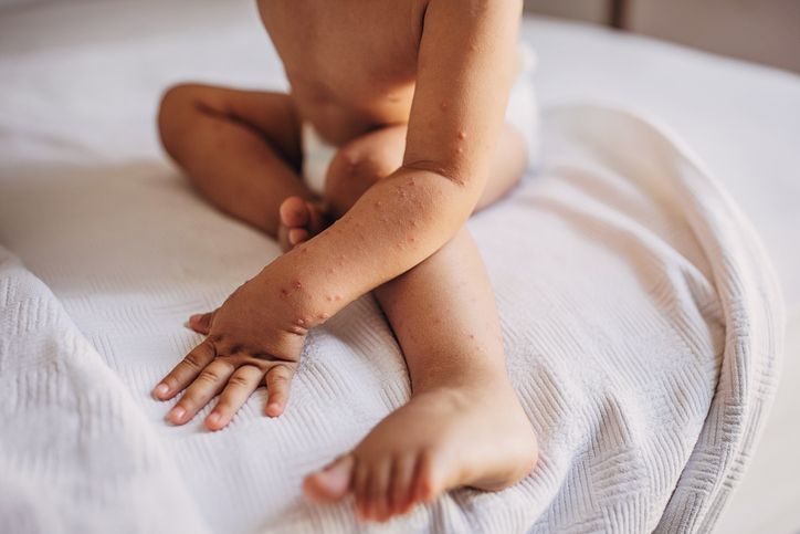 Flu Singapura jadi penyakit yang rentan menyerang anak usia di bawah 5 tahun, berikut berbagai gejala yang perlu diwaspadai.