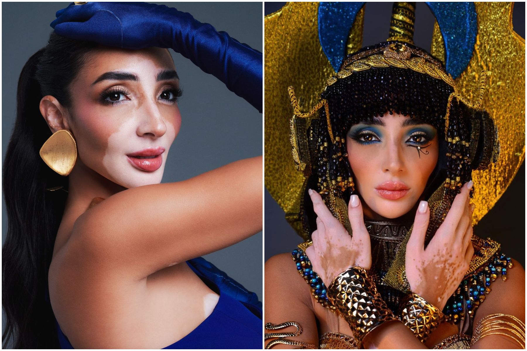 Dobrak stigma dan mencatatkan sejarah baru, Logina Salah menjadi kontestan Miss Universe pertama dengan vitiligo dan seorang ibu.