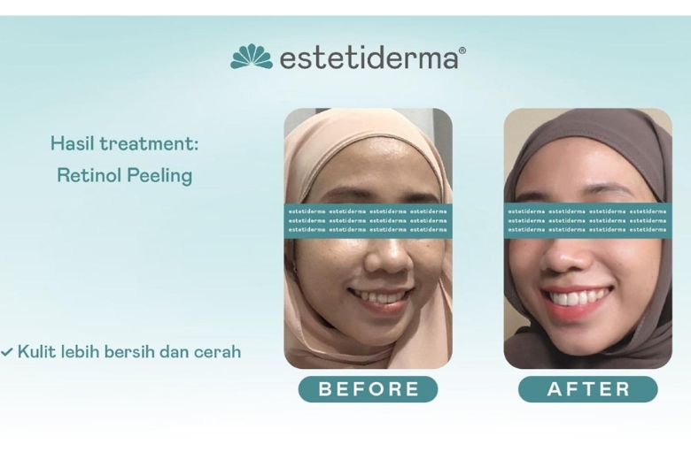 Retinol Peel adalah chemical peeling treatment yang bertujuan untuk mengeksfoliasi lapisan kulit paling atas dengan cairan peeling berbahan retinol.