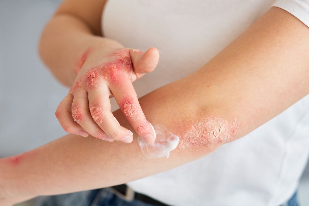 Berbahaya bagi kesehatan tubuh, ini alasan mengapa mesti segera berhenti minum obat jika muncul reaksi alergi.