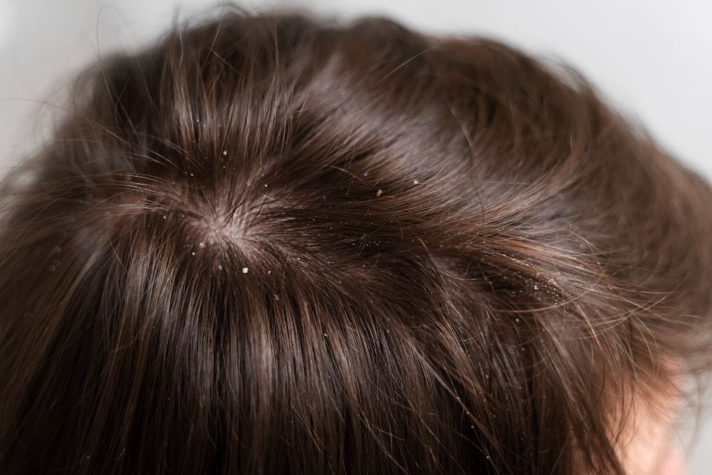 Anak-anak rentan terkena kutu rambut, orang tua perlu tahu berbagai penyebab yang mendasarinya. Simak penjelasan selengkapnya!