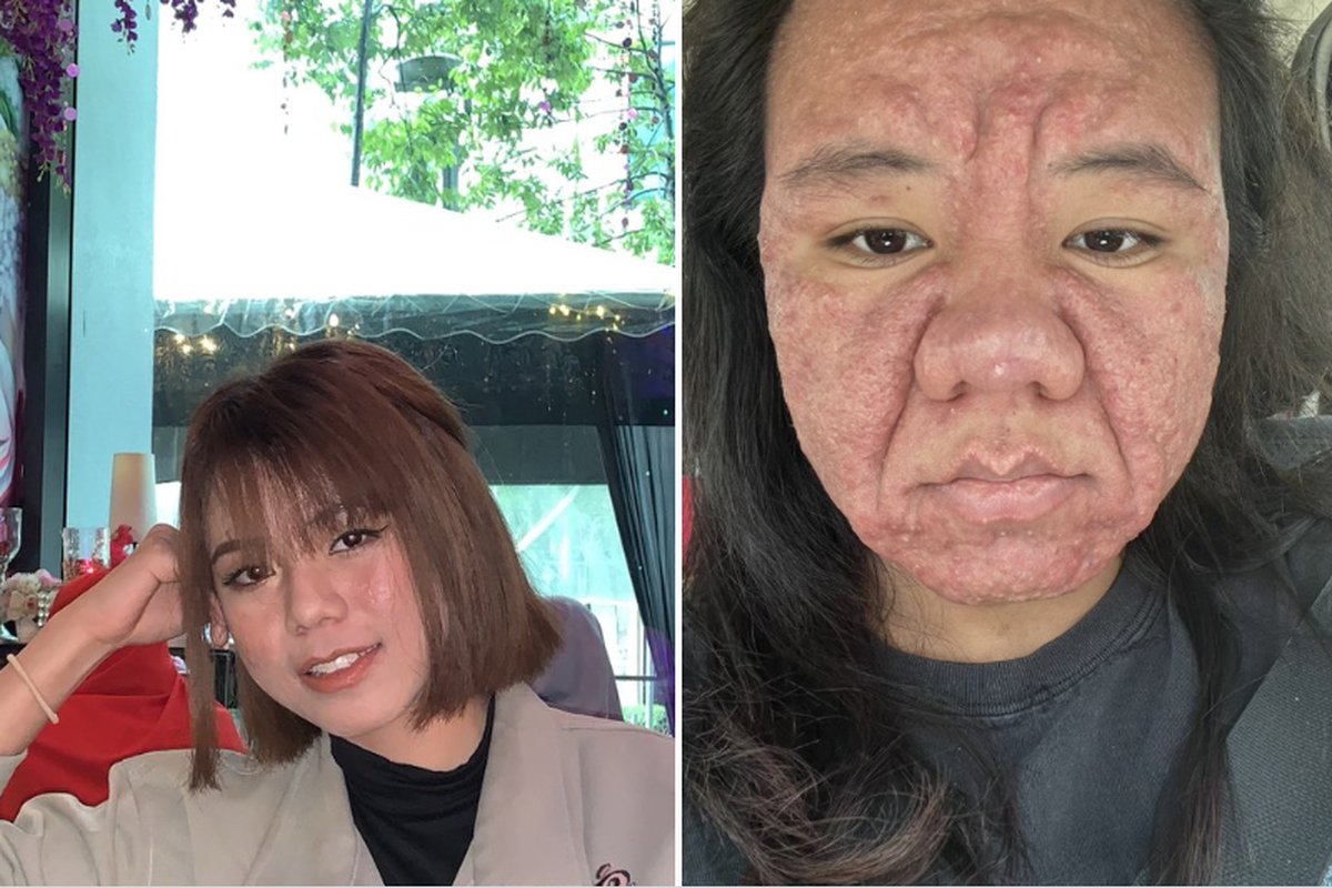 Mengenali seberapa besar perubahan pada tubuh perempuan selama masa kehamilan, belajar dari perubahan wajah yang dialami perempuan asal Malaysia ini.