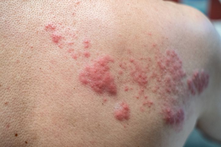 Melalui webinar Halodoc, Dokter Spesialis Kulit mengungkap fakta tentang cacar api atau herpes zoster yang selama ini dianggap ringan dan biasa.