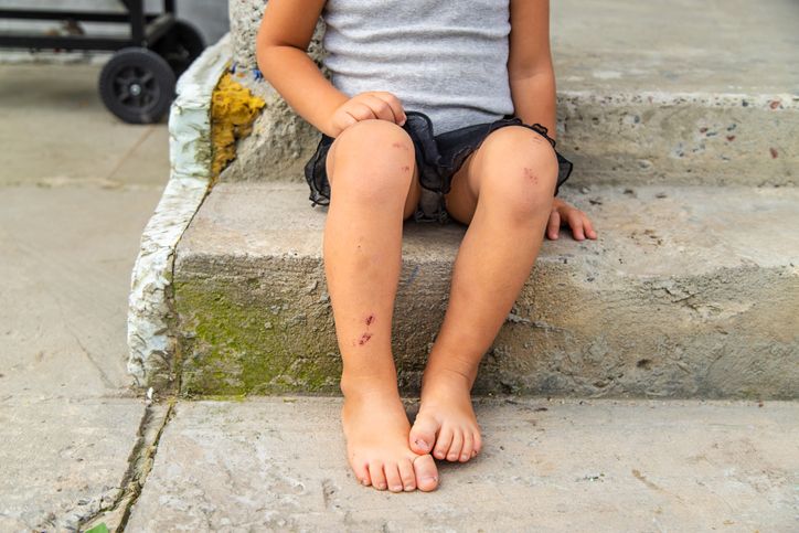 Beberapa bagian tubuh anak seperti kaki, lutut, siku mengalami lebam? Kenali penyebabnya dan kapan kamu perlu waspada.