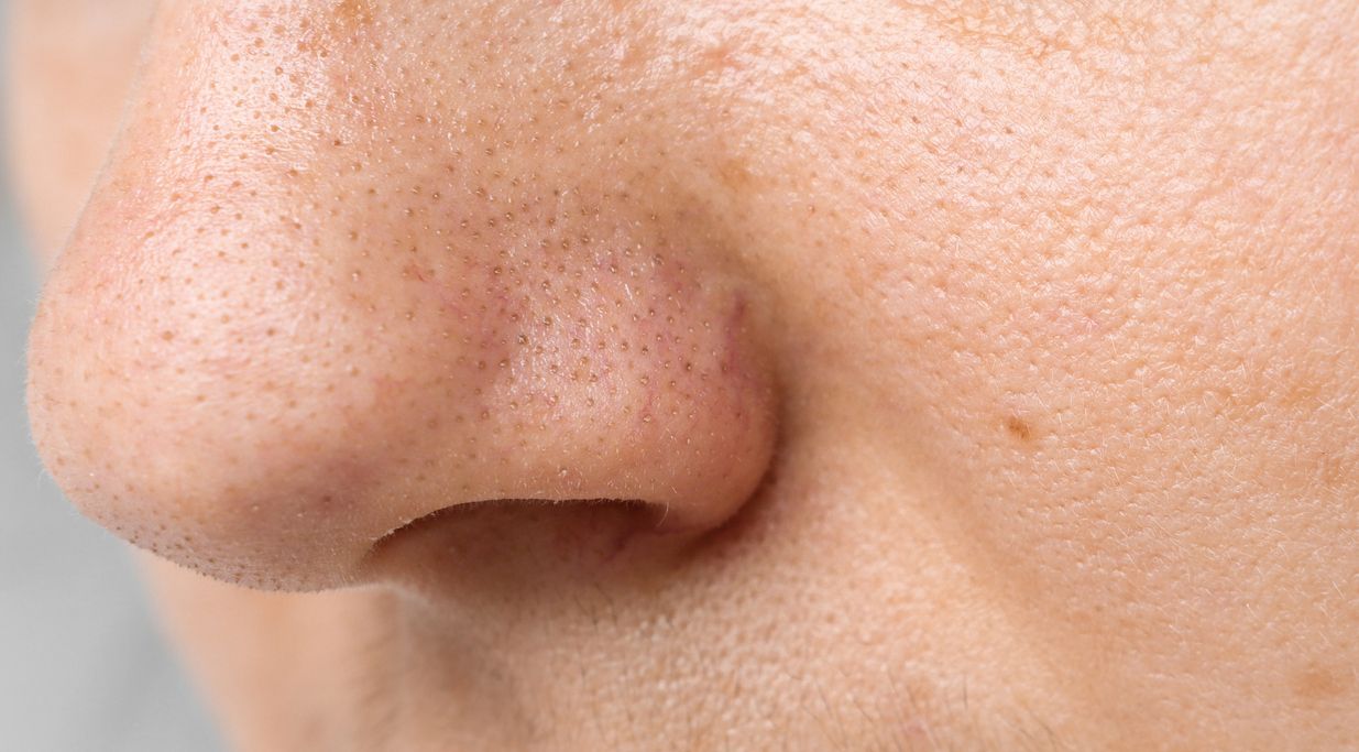 Pori-pori besar di hidung bikin enggak percaya diri? Ini lima langkah sederhana yang bisa dilakukan untuk mengatasinya.