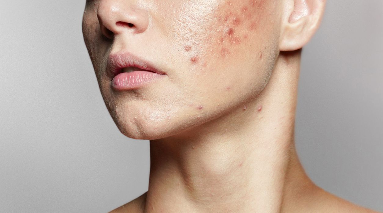 Dokter ungkap cara paling tepat untuk mengatasi adult acne yang biasanya lebih meradang dari jerawat biasa. Seperti apa?