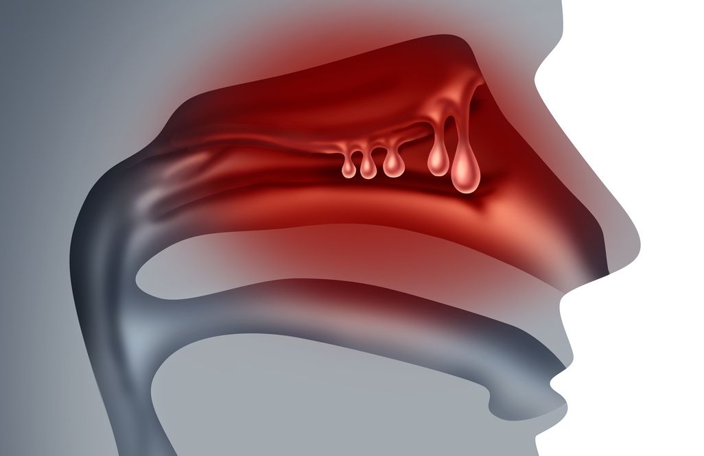 Polip hidung adalah tumbuhnya jaringan non-kanker di saluran hidung. Ketahui penyebab, gejala, dan cara pengobatannya berikut.