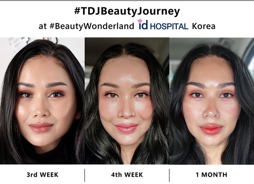 Titi DJ baru-baru ini melakukan operasi plastik untuk terlihat awet muda. Apa saja operasi plastik yang dilakukannya?